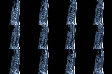 Torasik omurga sagital MRI geçmişinde sırt ağrısı ve T9 tıp ve eğitim konseptinde sıkışma kırığı var..