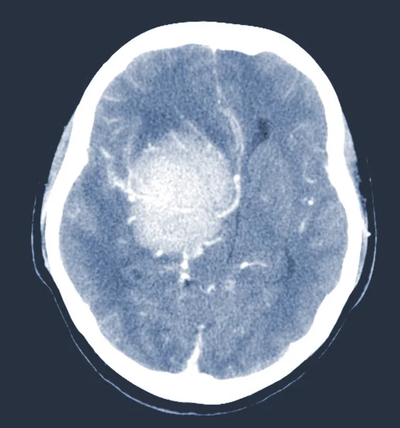 Ct脑轴索扫描位于右前庭 额顶叶区 脑水肿呈均匀 轻度的脑膜周围水肿 可见脑膜瘤 医疗图像概念 — 图库照片