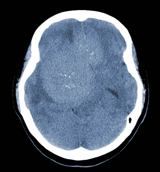 Brain Axial Escanea Masa Hiperdensa Con Edema Cerebral Homogéneo Perilesional —  Fotos de Stock