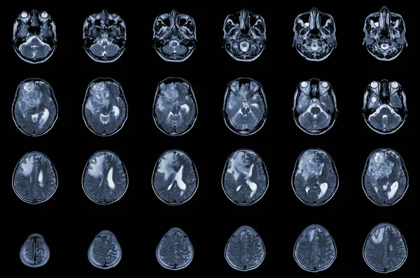 Mri Hersenen Axiale Standpunten Hersentumor Evalueren Glioblastoom Hersenmetastasenisodichtheidsmassa Met Een — Stockfoto