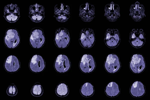 Rezonans Mózgu Widoki Osiowe Oceny Guza Mózgu Glioblastoma Przerzuty Mózgu — Zdjęcie stockowe