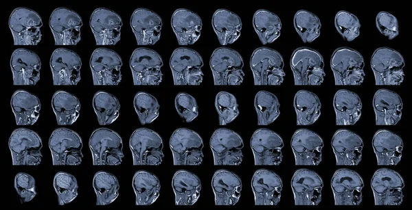 Mri脳Axialビュー脳腫瘍を評価します 右前頭葉に不明確な縁と周囲の浮腫を有する脳転移のアイソトープ質量である神経芽腫 — ストック写真