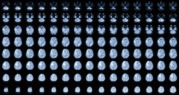 MRI Brain Axial views .to evaluate brain tumor. Glioblastoma, brain metastasis isodensity mass with an ill-defined margin and surrounding edema at the right frontal lobe.