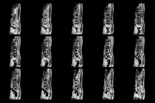 Mri Thoracolumbar Spine Pacjenta Umiarkowanymi Lub Ciężkimi Złamaniami Kompresyjnymi Poziomu — Zdjęcie stockowe