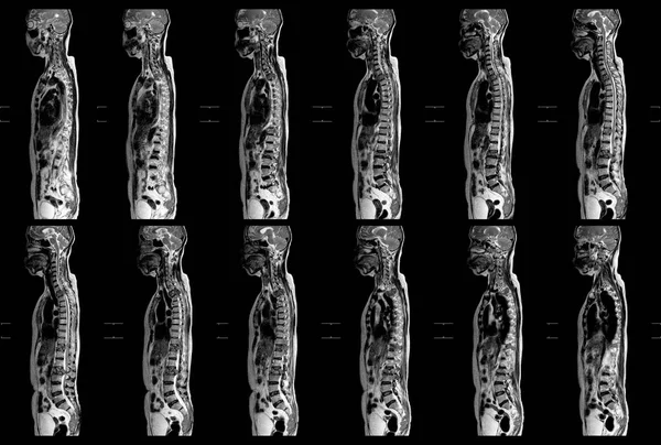 Mri Thoracolumbar Spine Пациентка Умеренными Тяжелыми Компрессионными Переломами Уровня T11 — стоковое фото