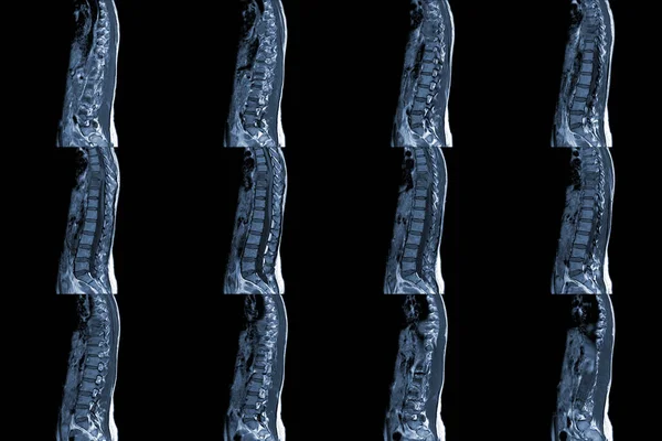 Mri Thoracic Spine Sagittal History Back Pain Compression Fracture Medical — Stock Photo, Image