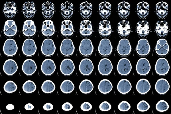 Scan Мозок Гострий Верхній Субазурній Гематомі Sdh Поряд Лівою Півкулею — стокове фото