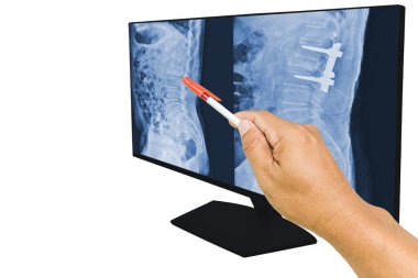 Doktor L1-L2 'deki omurga kırığının MRI taramasını rapor etti. Ve demir çubuk ve vidayla düzeltilen ameliyat sonrası. Tıp eğitimi kavramı.