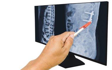 Doktor L1-L2 'deki omurga kırığının MRI taramasını rapor etti. Ve demir çubuk ve vidayla düzeltilen ameliyat sonrası. Tıp eğitimi kavramı.