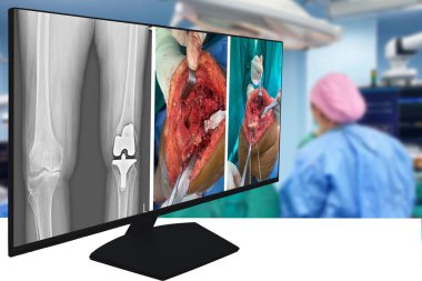Bir grup doktor, ameliyat odasındaki osteoartrit hastalarında diz protezi ameliyatı yapıyor. Seçici odaklı tıp eğitimi konsepti. Toplam diz protezi artroplasti.