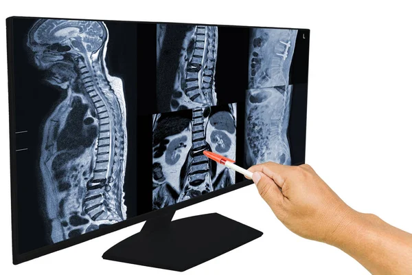 stock image The doctor reported the MRI scans of the lumbar spine compression fracture Bulging of L1-L2. and Post operation fixed by iron rod and screws. Medical education concept.