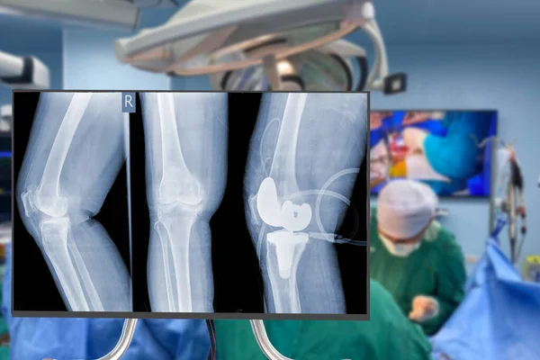 x-ray of  knee. Blurry Traumatology orthopedic surgery hospital operating room for the Total Knee Replacement operation. Medical health and Education concept.