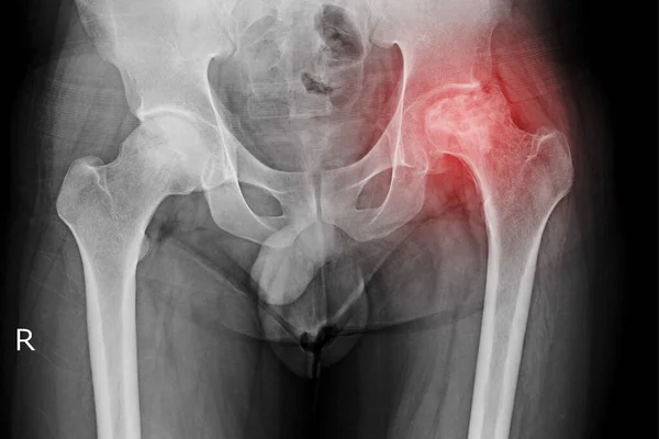 Пельвіс Рентгенівський Знімок Кульшового Суглоба Пацієнта Болем Стегні Показує Аварійний — стокове фото