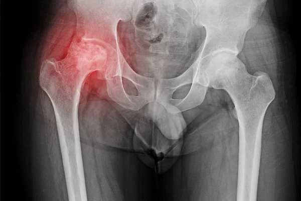 髋关节疼痛患者的骨盆和髋部X线显示髋关节右侧血管坏死和继发性骨关节炎 病人需要全髋关节置换术 — 图库照片