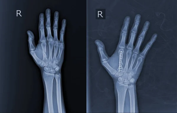 Röntgen 2Th Metacarpal Fraktürü Için Plaka Saplantısı Gösteriyor Tıbbi Görüntü — Stok fotoğraf