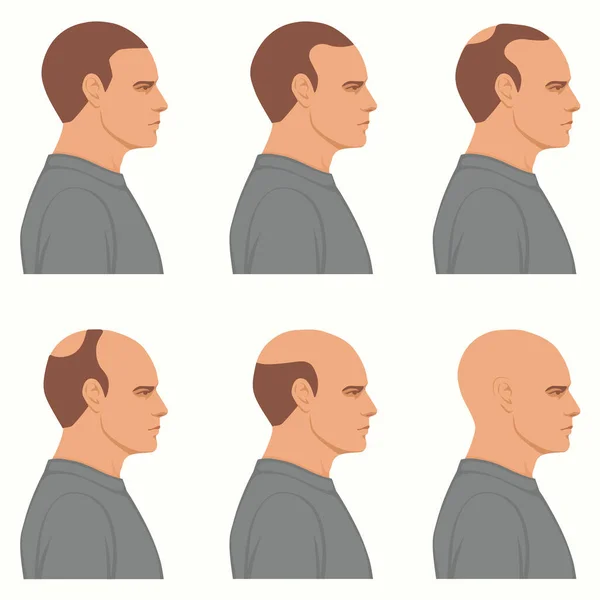 显示男性脱发阶段的信息图表 头皮从满头的毛发到秃顶的最后阶段 — 图库矢量图片