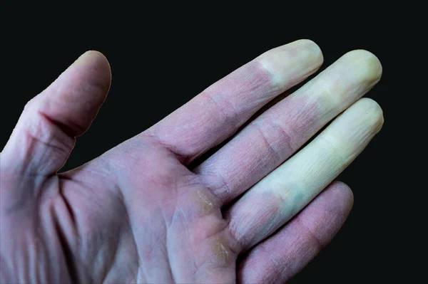 Ένα Ψυχρό Αρσενικό Χέρι Σύνδρομο Raynaud Φαινόμενο Του Raynaud Νόσο — Φωτογραφία Αρχείου