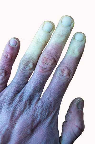 Mrazivá Mužská Ruka Raynaudovým Syndromem Raynaudovým Fenoménem Nebo Raynaudovou Chorobou — Stock fotografie