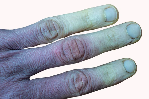 Uma Mão Masculina Congelada Com Síndrome Raynaud Fenômeno Raynaud Doença — Fotografia de Stock