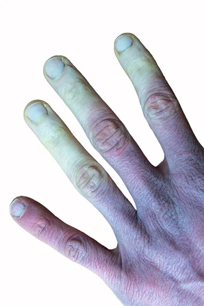 Обмороженная Мужская Рука Синдромом Рейно Феноменом Рейно Болезнью Рейно Изолированной — стоковое фото