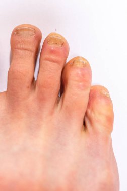 Tırnak mikozu (onychomycosis) ile enfekte olmuş üç küçük ayak parmaklı yetişkin bir erkek ayağının yakın çekimi).