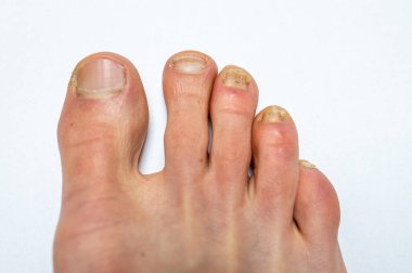 Tırnak mikozu (onychomycosis) ile enfekte olmuş üç küçük ayak parmaklı yetişkin bir erkek ayağının yakın çekimi).