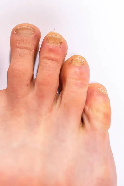Крупный План Взрослой Мужской Ноги Тремя Маленькими Пальчиками Инфицированными Микозом — стоковое фото