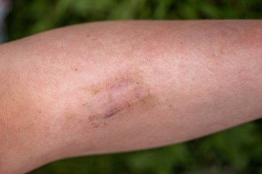 Bisikletten düştükten sonra bacağında morluk olan bir çocuğun yakın çekimi..