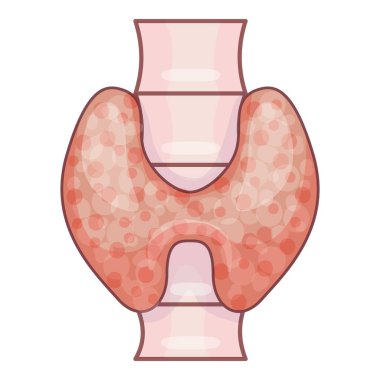 Otoimmün hastalıklı bir insan tiroit bezinin canlandırılması, genişlemiş ve iltihaplanmış bir görünüm gösteriyor.