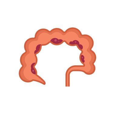 Divertikül iltihabı olan kalın bir bağırsağın görüntüsü, kolonu etkileyen bir sindirim bozukluğu.