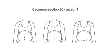Sezaryen bölümü vektör çizgisi, hamile bir kadının çizimi