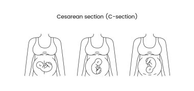 Sezaryen bölümü vektör çizgisi, hamile bir kadının çizimi