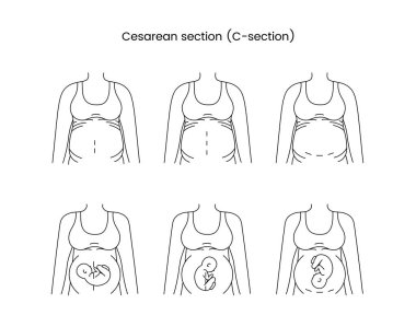 Caesarean section views icon line in vector, illustration of a pregnant woman clipart