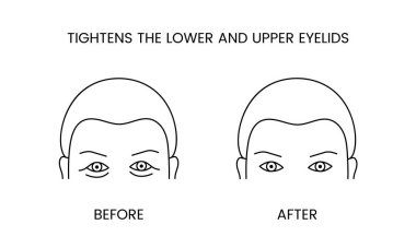 Prosedürden önce ve vektör içinde tedavi çizgisi simgesi uyguladıktan sonra göz kapağını ve üst ve alt kozmetolojiyi sıkılaştırır. Pürüzsüz, pürüzsüz cilt ve kırışıklıkları olan bir adam tasviri.