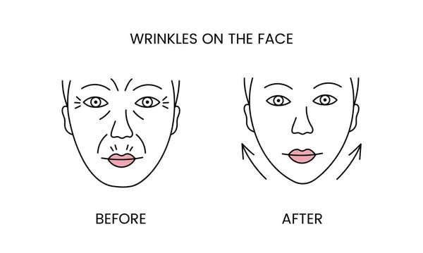 Keriput Wajah Kosmetologi Laser Sebelum Prosedur Dan Setelah Menerapkan Ikon - Stok Vektor