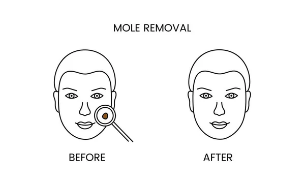 stock vector Mole removal, laser cosmetology before procedure and after applying treatment line icon in vector. Illustration of a man with smooth clean skin and problematic skin.