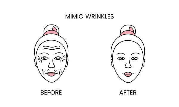 stock vector Mimic wrinkles, laser cosmetology before procedure and after applying treatment line icon in vector. Illustration of a woman with smooth clean skin and problematic skin