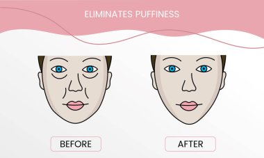 Prosedürden önce şişkinliği, lazer kozmetolojiyi ve tedaviyi vektöre uyguladıktan sonra ortadan kaldırır. Pürüzsüz, temiz ciltli ve sorunlu bir kadının tasviri