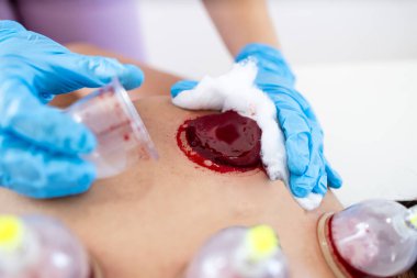 Hijama uzmanı tedavi sonrası kaptaki pıhtılaşmış kılcal damarları temizliyor..