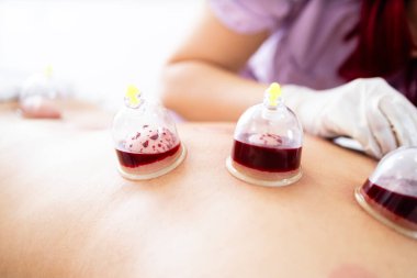 Profesyonel terapist içi kan dolu bardaklarla hijama tedavisi uyguluyor. Sırt ağrısı, artrit ve romatizma için alternatif ilaçlar..