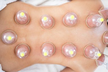 Kadının sırtındaki hijama tedavisinin en üst görüntüsü..