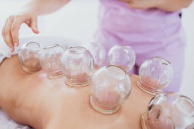 Hasta sırtına hijama tedavisi uygulayan profesyonel bir kadın terapist. Kronik ağrıyı dindirmek için ısıtılmış vakum bardakları yerleştiriyorum..