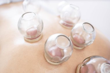 Hijama tedavisi ya da daha iyi sağlık ve ağrı kesiciler için kuru temizleme.