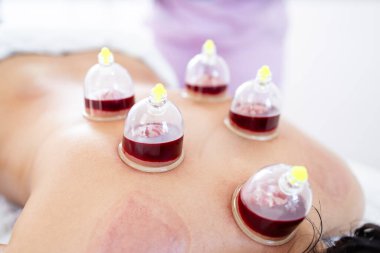 Hijama bardakları kadının vücudunda kanla dolu..