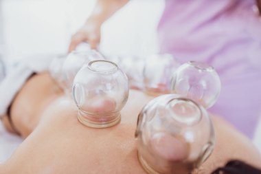 Hasta sırtına hijama tedavisi uygulayan profesyonel bir kadın terapist. Kronik ağrıyı dindirmek için ısıtılmış vakum bardakları yerleştiriyorum..