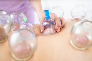 Hijama kupa terapisi sırasında doldurulan vakum bardaklarının görüntüsünü kapat.