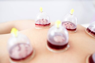 Hijama kupa terapisi sırasında kanla dolu vakum bardaklarının yakın görüntüsü.
