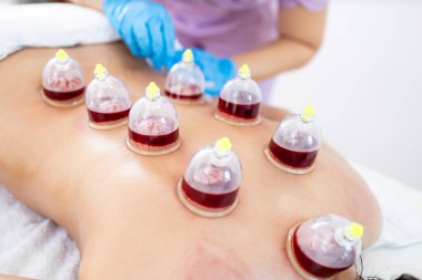 Hijama ustası hasta cildinde vakum kan emme prosedürü uygular..