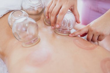 Hijama alternatif tıp terapisi kronik ağrı kesici ve rahatlama için. Vakumlu bardaklara odaklan.