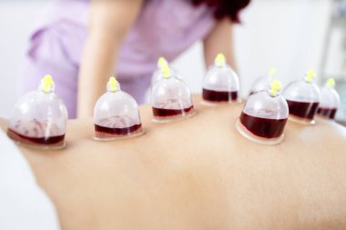 Hasta sırtına hijama tedavisi uygulayan profesyonel bir terapist. Kanla dolu vakum bardaklarına odaklan. Ağrı kesici ve gevşeme için alternatif ilaç.